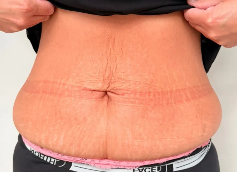August 2026 You Aesthetics Staffordshire Ltd Collagen Lift on Tummy for Sagging Skin Before