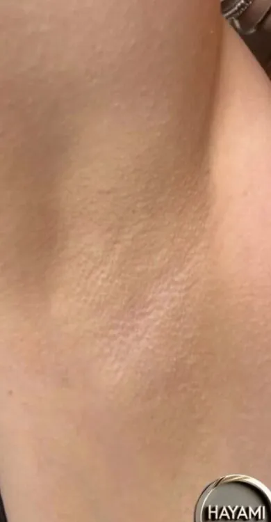 Hayami-Cosmetics-IPL-Hair-Reduction-on-Arms-After