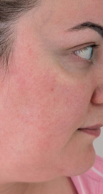 July 2026 Bear Beauty IPL Vascular Facial for Rosacea After
