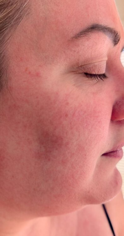 July 2026 Bear Beauty IPL Vascular Facial for Rosacea Before