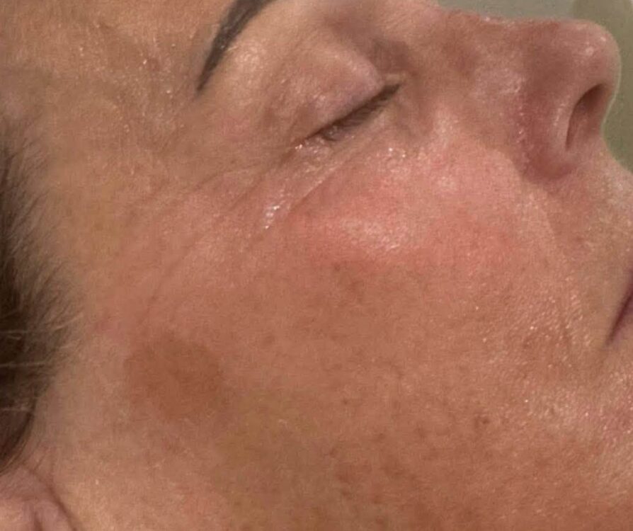 July 2026 Neu You Complimentary Therapies Microdermabrasion Facial for Pigmentation After