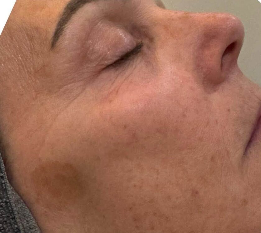 July 2026 Neu You Complimentary Therapies Microdermabrasion Facial for Pigmentation Before