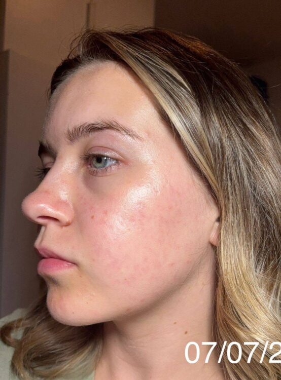 July 2026 Rebecca Nails and Beauty Specialist Hydro Facial for Acne After
