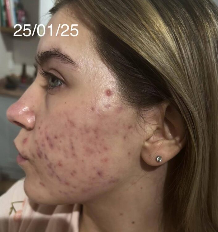 July 2026 Rebecca Nails and Beauty Specialist Hydro Facial for Acne Before
