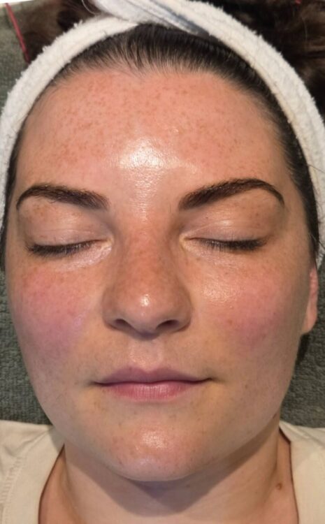 July 2026 Skinoveve Hydro Facial for Puffy Skin After