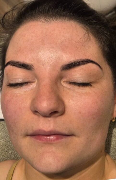 July 2026 Skinoveve Hydro Facial for Puffy Skin Before