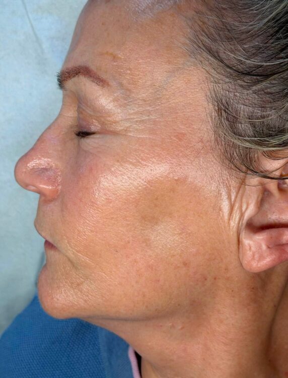 July 2026 TLV Beauty IPL Vascular Facial for Rosacea After