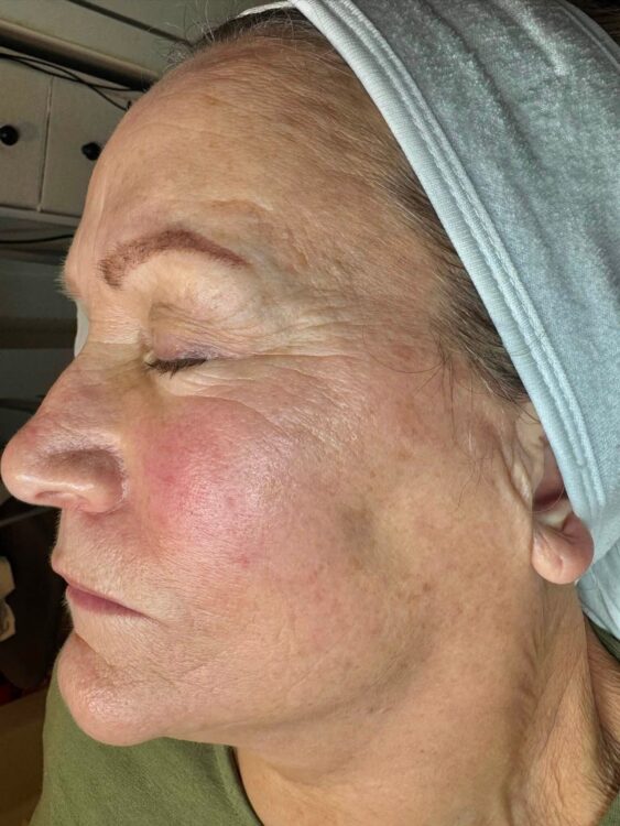 July 2026 TLV Beauty IPL Vascular Facial for Rosacea Before