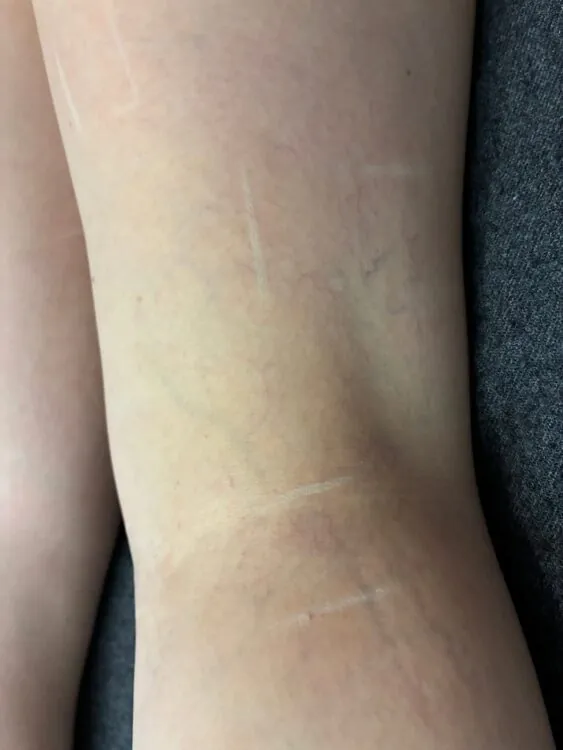 June 2026 Ayano Spa IPL Vascular on Arms for Thread Veins After