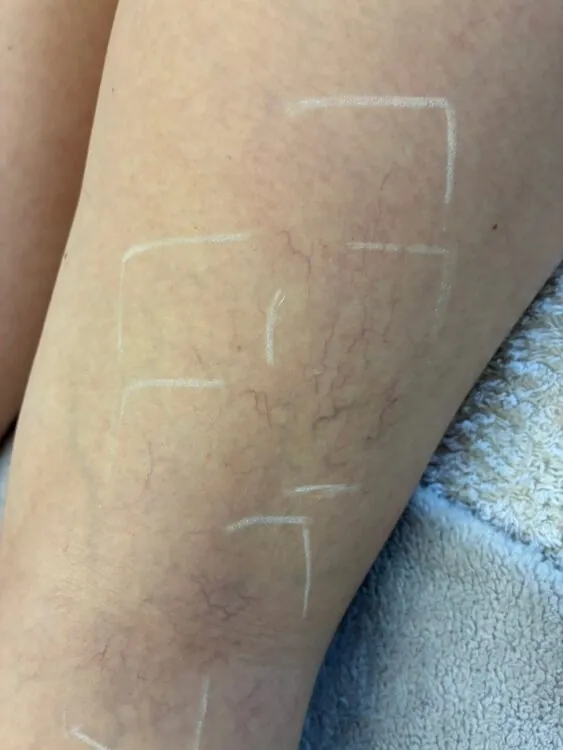June 2026 Ayano Spa IPL Vascular on Arms for Thread Veins Before