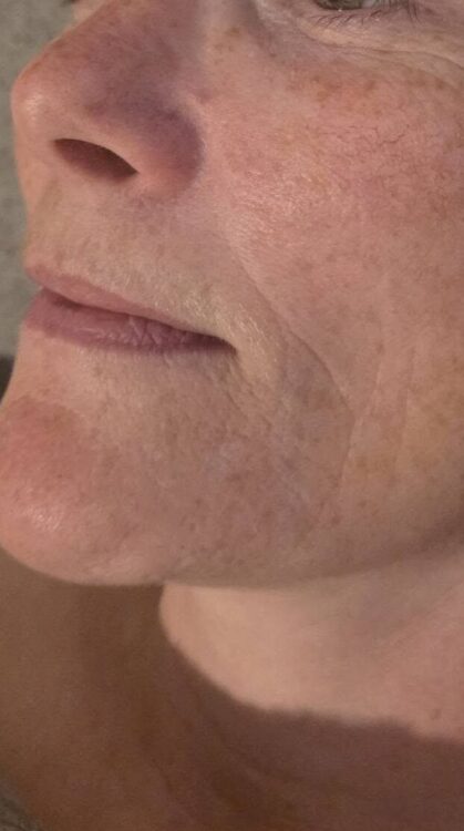June 2026 Beauty by Rebecca Alice Microdermabrasion Facial for Ageing Skin Before