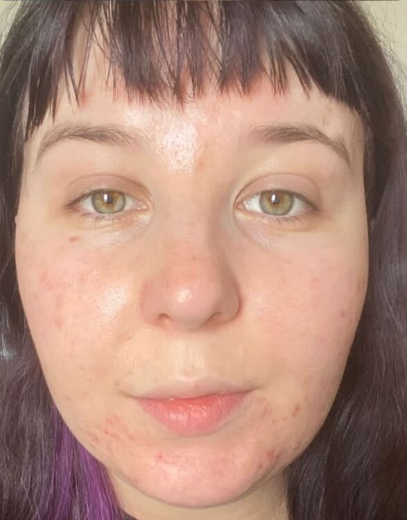 June 2026 Bude Skin Clinic Microdermabrasion Facial for Acne After