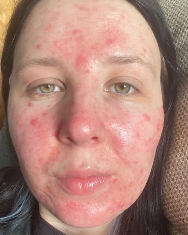 June 2026 Bude Skin Clinic Microdermabrasion Facial for Acne Before