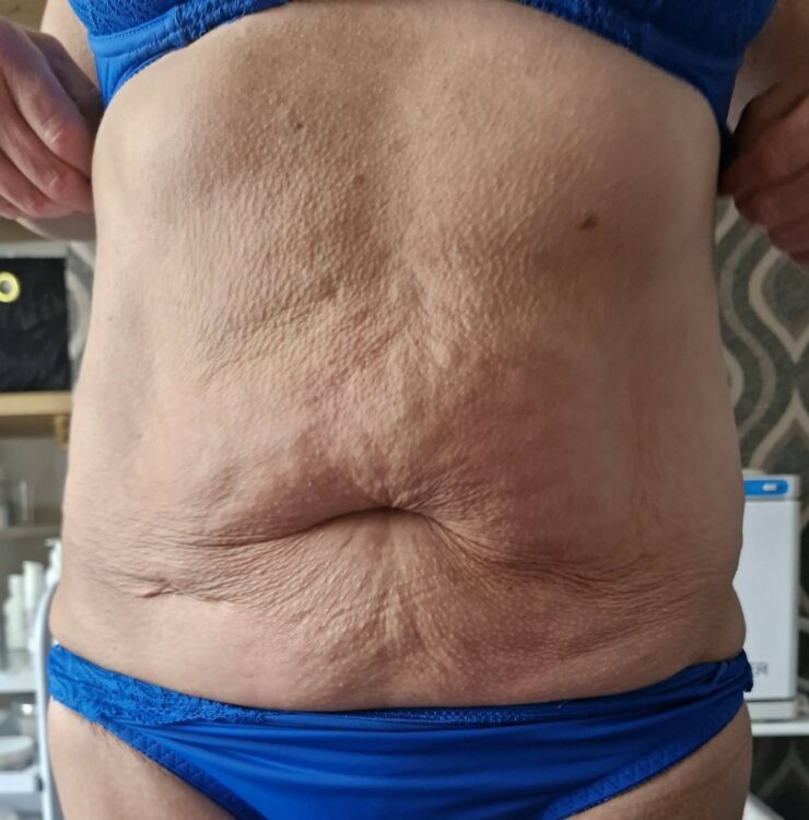 June 2026 Gingers Nails & Beauty Collagen Lift on Tummy for Sagging Skin After