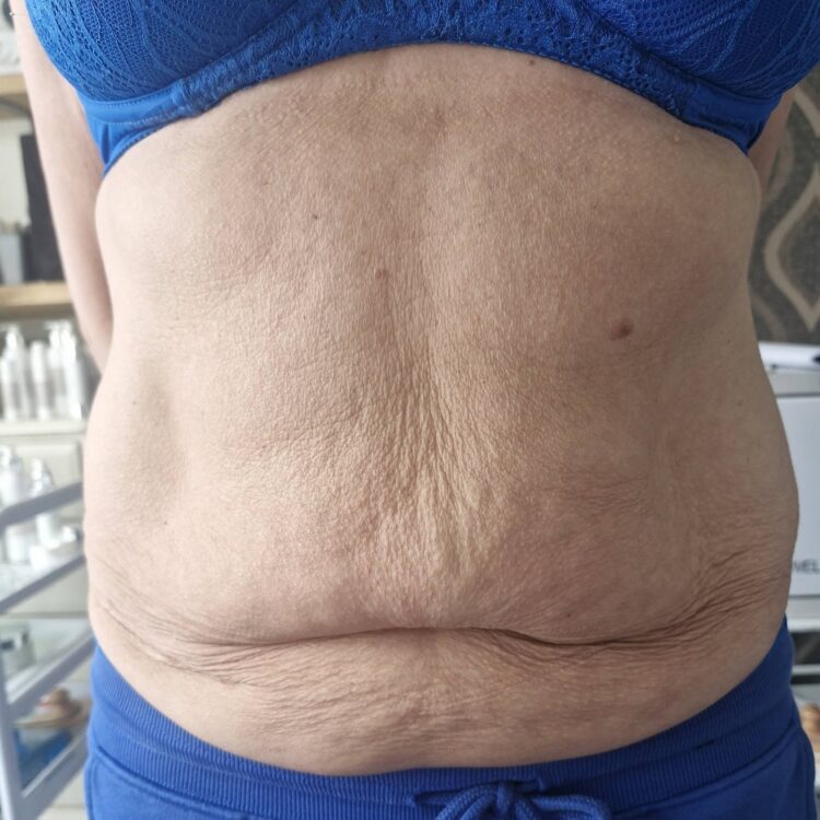 June 2026 Gingers Nails & Beauty Collagen Lift on Tummy for Sagging Skin Before