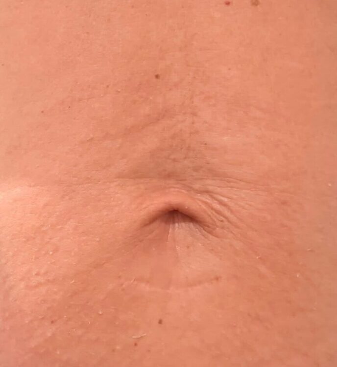 June 2026 House of Skin Collagen Lift on Tummy for Sagging Skin After