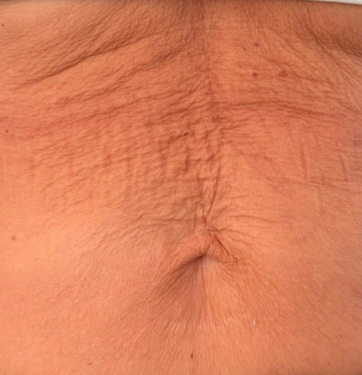 June 2026 House of Skin Collagen Lift on Tummy for Sagging Skin Before