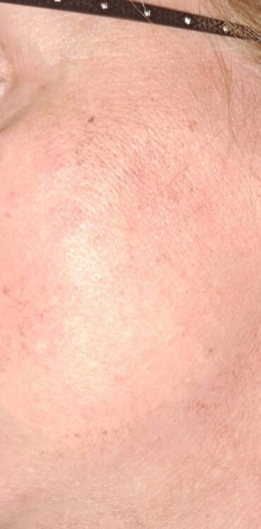 June 2026 House of Skin IPL Vascular Facial for Pigmentation After
