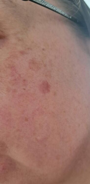 June 2026 House of Skin IPL Vascular Facial for Pigmentation Before