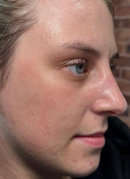 June 2026 Luminous Skin Clinic Cheshire Microdermabrasion Facial for Acne After