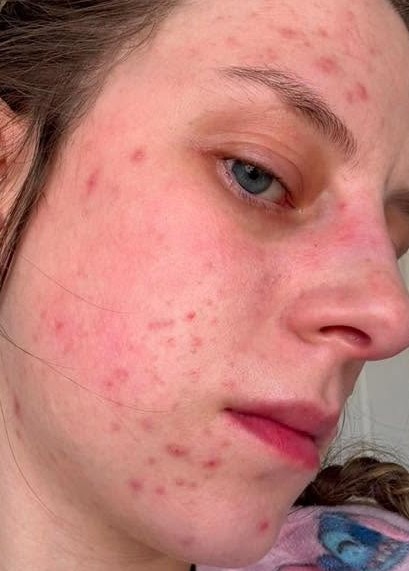 June 2026 Luminous Skin Clinic Cheshire Microdermabrasion Facial for Acne Before