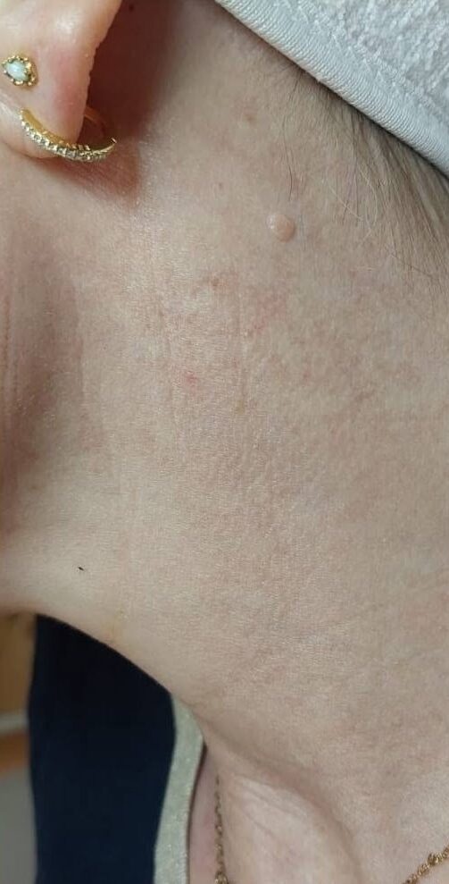 June 2026 Perry Walker Skincare Specialist IPL Vascular Facial for Pigmentation After