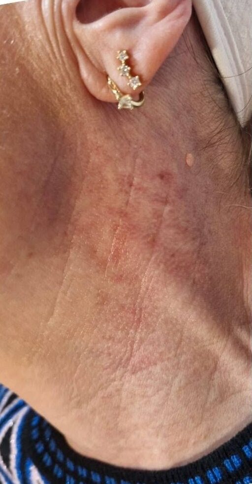 June 2026 Perry Walker Skincare Specialist IPL Vascular Facial for Pigmentation Before