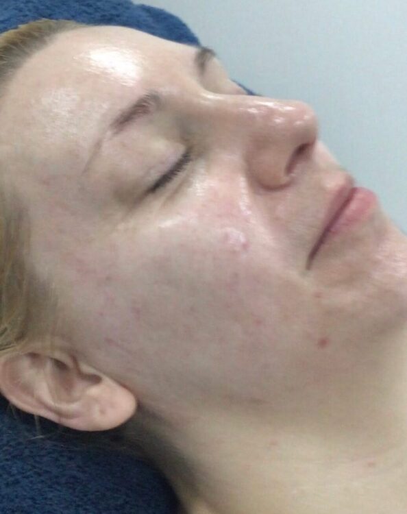 June-2026-ProTherapies-Microdermabrasion-Facial-for-Acne-After
