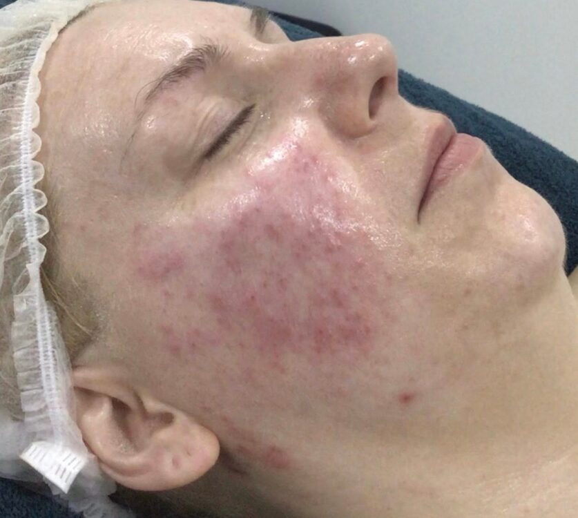 June 2026 ProTherapies Microdermabrasion Facial for Acne Before