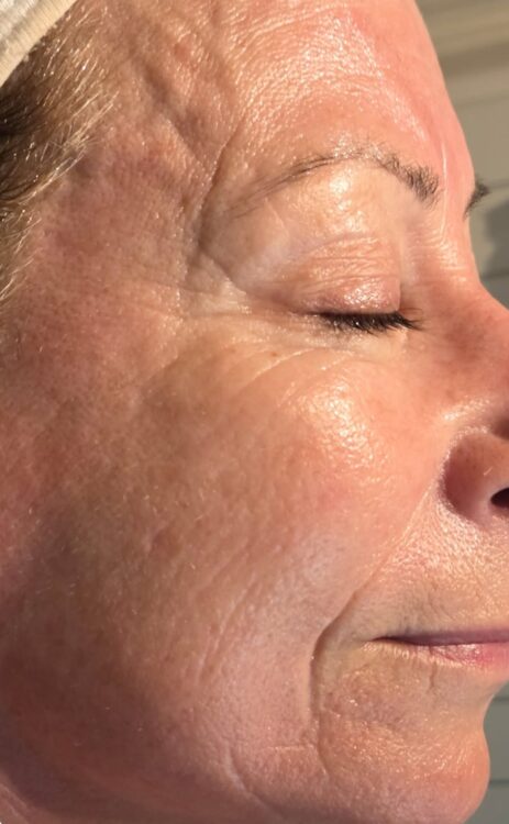 June 2026 Skinoveve Collagen Lift Facial for Ageing Skin After