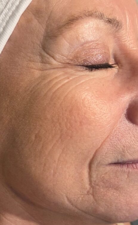 June 2026 Skinoveve Collagen Lift Facial for Ageing Skin Before