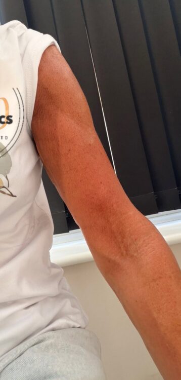 June 2026 You Aesthetics Staffordshire Ltd Collagen Lift on Arms for Ageing Skin After
