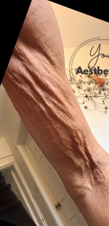 June 2026 You Aesthetics Staffordshire Ltd Collagen Lift on Arms for Ageing Skin Before