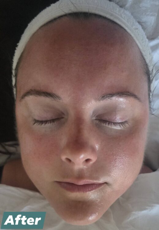 May 2026 Bobbi Brooklyn Aesthetics Clinic Hydro Facial for Uneven Skin After