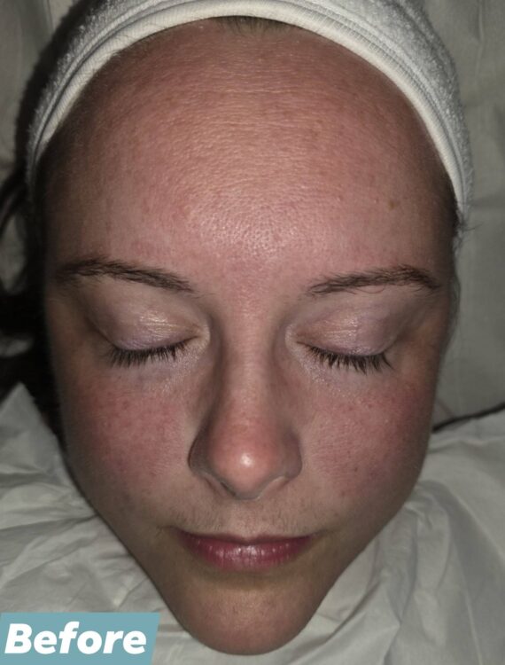May 2026 Bobbi Brooklyn Aesthetics Clinic Hydro Facial for Uneven Skin Before