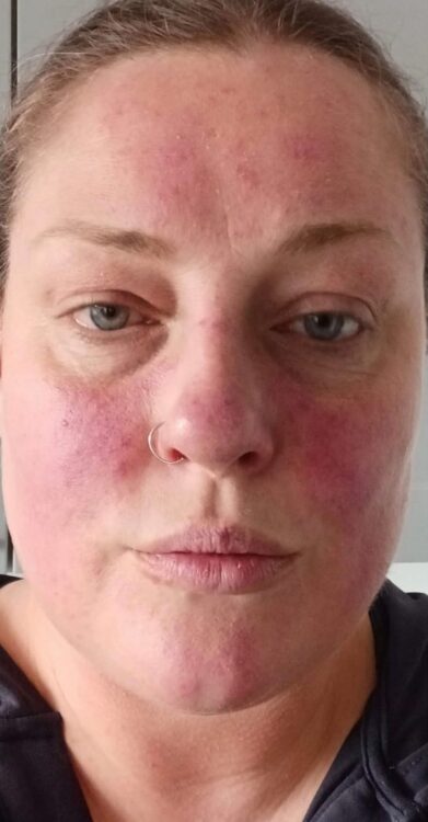 May 2026 Bodyology Microdermabrasion Facial for Uneven Skin Before