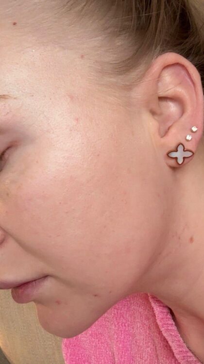 May 2026 Refined Beauty Yeovil Hydro Facial for Acne After