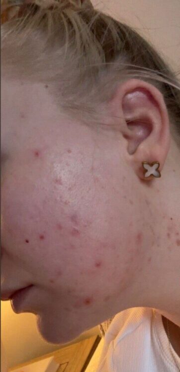 May 2026 Refined Beauty Yeovil Hydro Facial for Acne Before