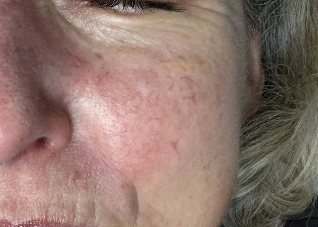 May 2026 TLV Beauty IPL Vascular Facial for Thread Veins After