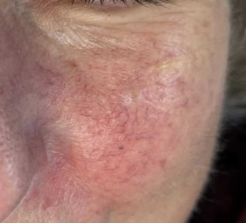 May 2026 TLV Beauty IPL Vascular Facial for Thread Veins Before