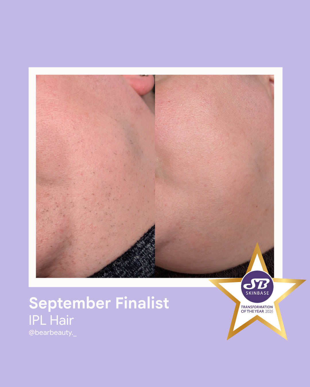 74 September Finalist 2026 Bear Beauty IPL Hair