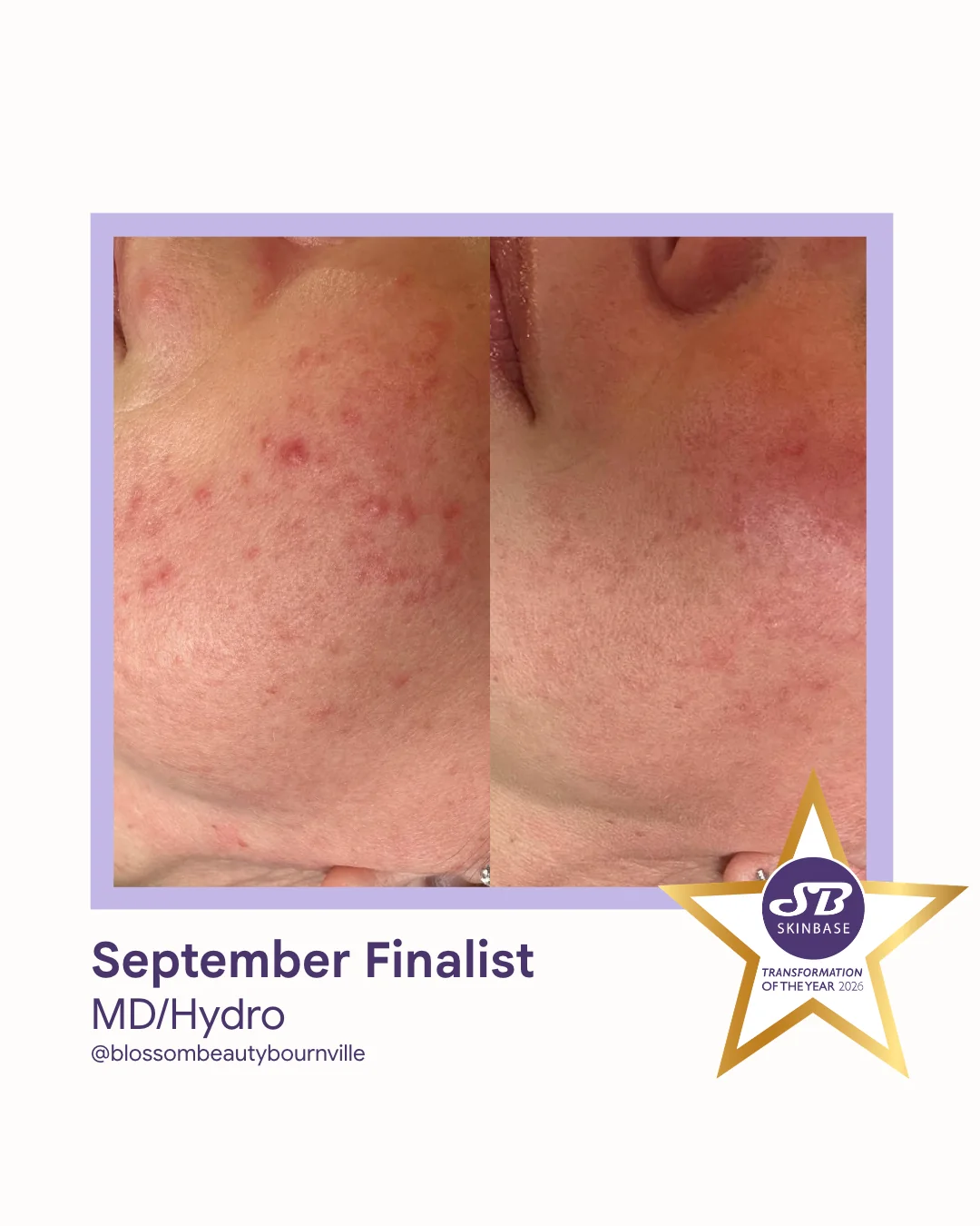 75 September Finalist 2026 Blossom Beauty Bournville MD Hydro