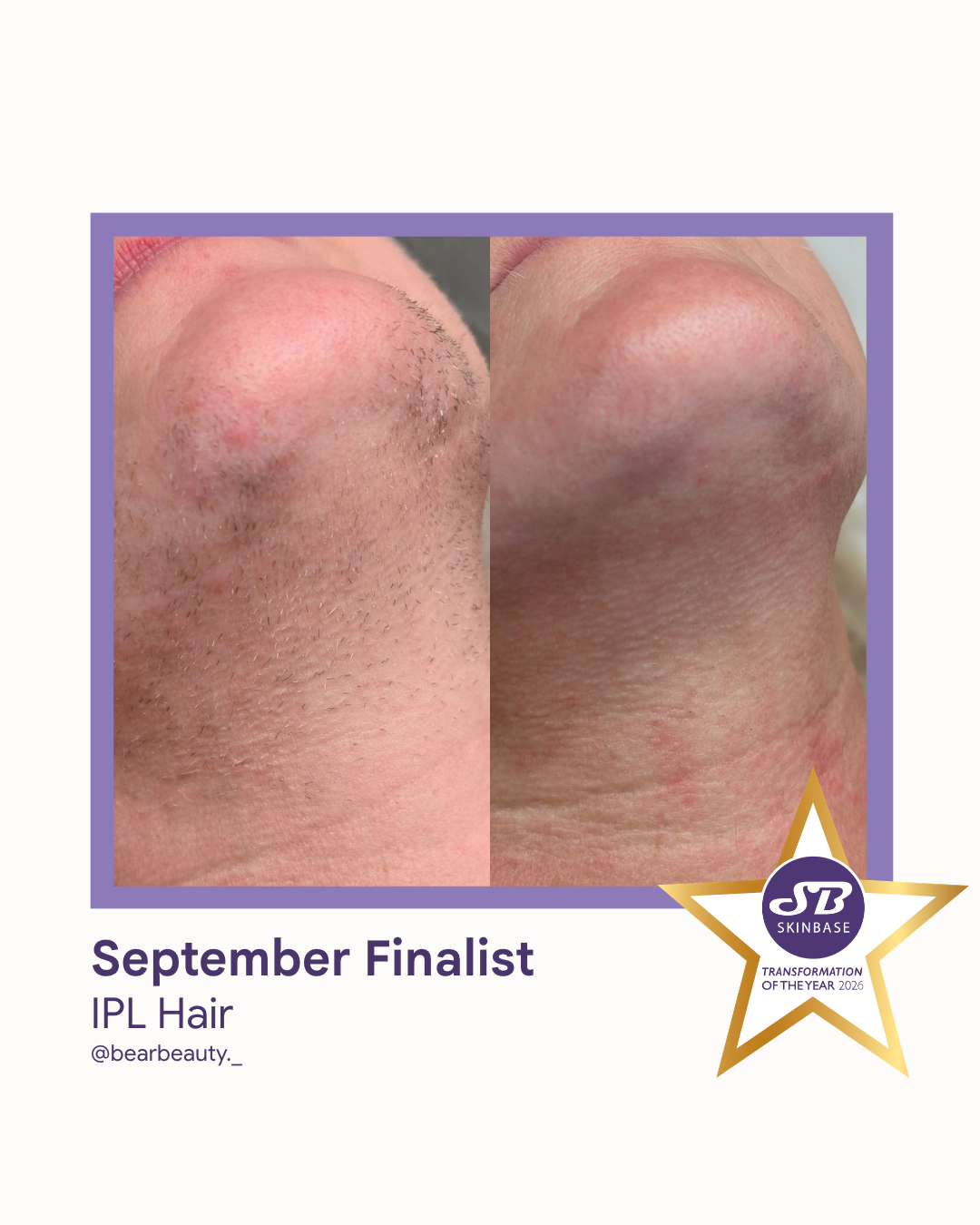 76 September Finalist 2026 Bear Beauty IPL Hair
