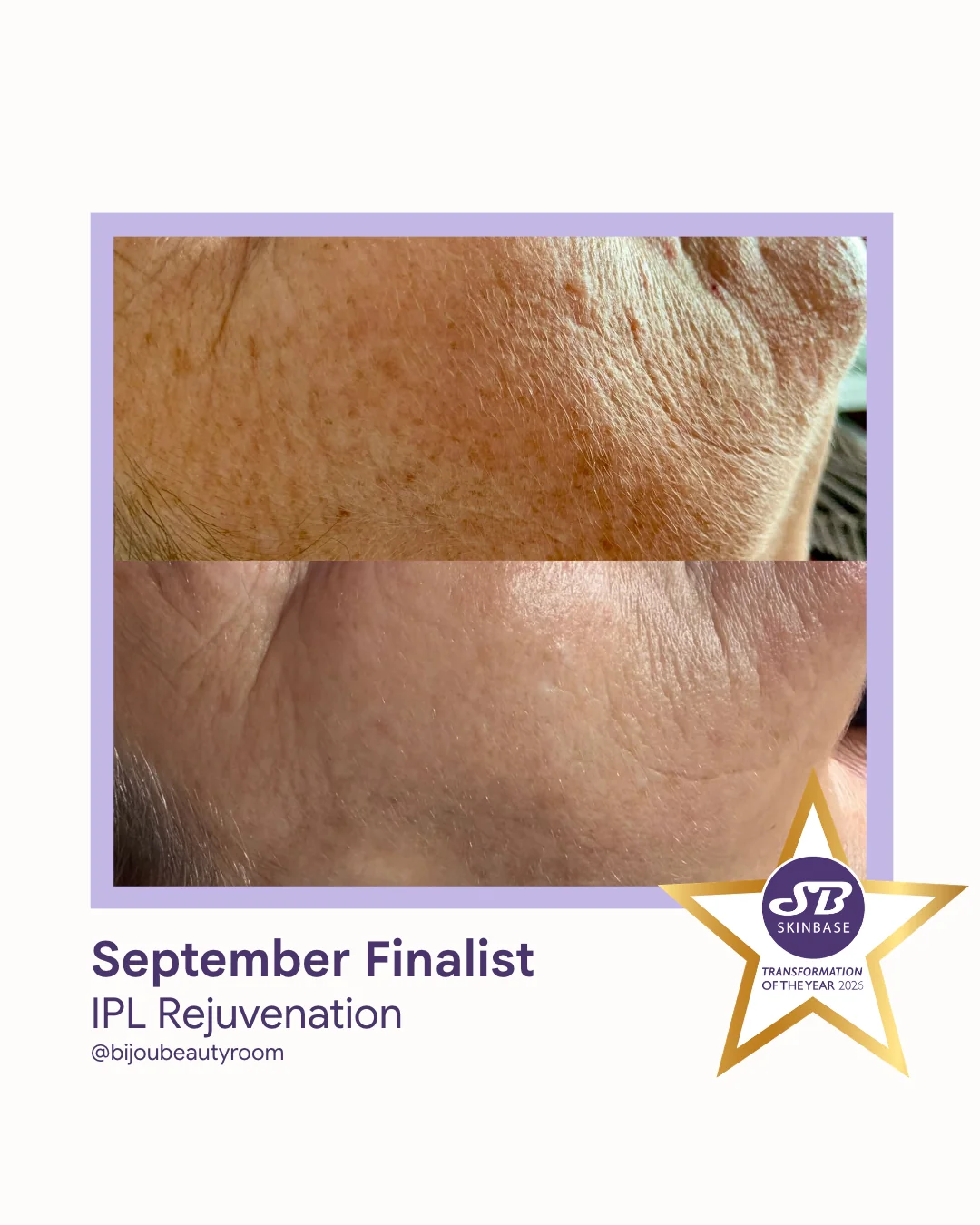 77 September Finalist 2026 Bijou Beauty Room IPL