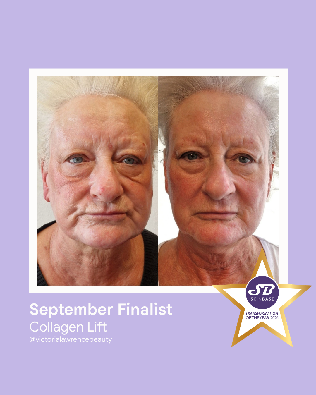 78 September Finalist 2026 Victoria Lawrence Beauty Collagen Lift