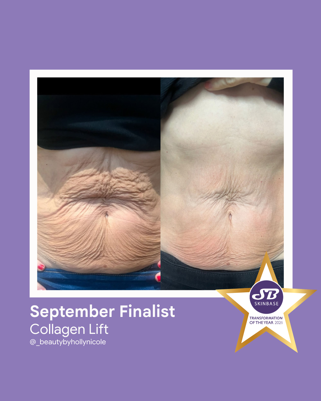 79 September Finalist 2026 Beauty by Holly Nicole Collagen Lift