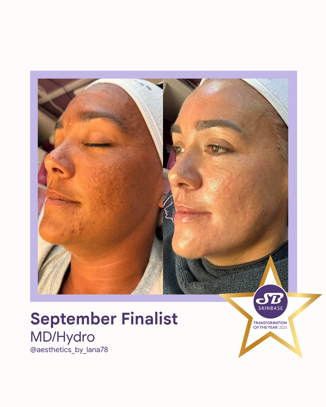 80 September Finalist 2026 Aesthetics by Lana MD Hydro