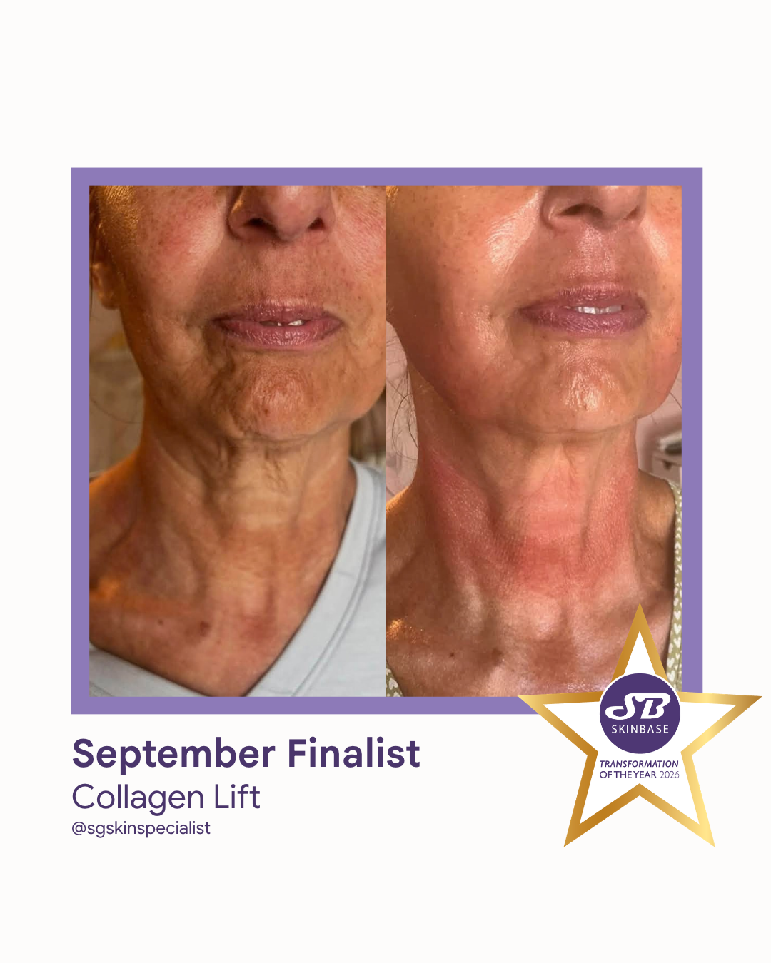 81 September Finalist 2026 SG Skin Specialist Collagen Lift
