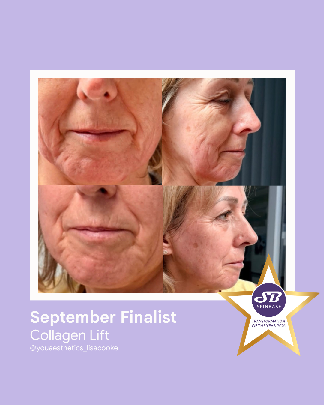 82 September Finalist 2026 You Aesthetics Staffordshire Ltd Collagen Lift