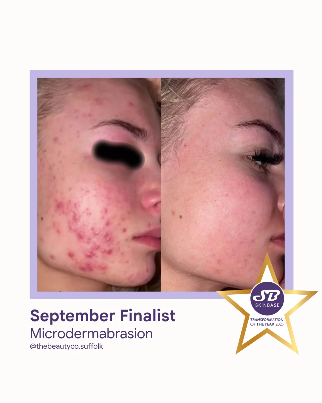83 September Finalist 2026 The Beauty Co Suffolk Microdermabrasion